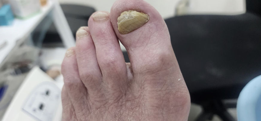 Symptoms of thickened toenails